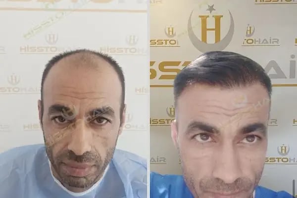 İzmir Saç Ekimi Merkezi - Hisstohair | Fue saç ekimi | PRP ve Mezoterapi | Sakal ekimi | Kaş ekimi - Resim 14
