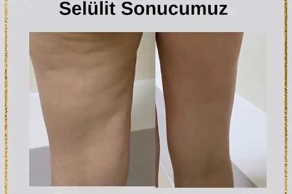 Hülya Yılmaz Beauty (Lazer Epilasyon, Cilt Bakımı, Kalıcı Makyaj, Microblading) - Resim 5