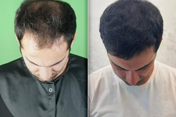 One Hair Clinic Transplantation - Plastic Esthetic - Resim 6