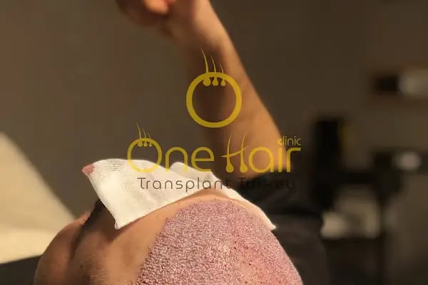 One Hair Clinic Transplantation - Plastic Esthetic - Resim 9