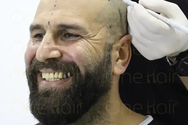 One Hair Clinic Transplantation - Plastic Esthetic - Resim 10