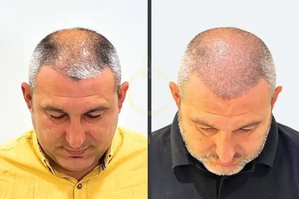One Hair Clinic Transplantation - Plastic Esthetic - Resim 19