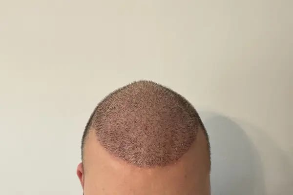 One Hair Clinic Transplantation - Plastic Esthetic - Resim 16