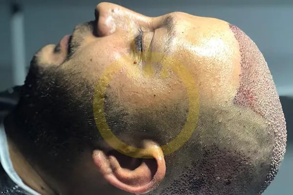One Hair Clinic Transplantation - Plastic Esthetic - Resim 2