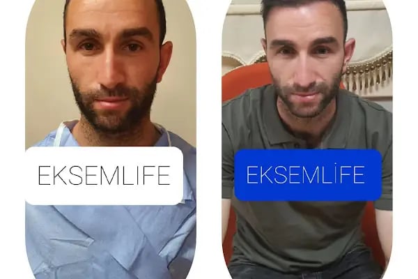 Eksem Life - Malatya Saç Ekimi - Resim 7