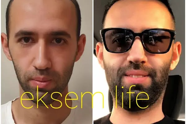 Eksem Life - Malatya Saç Ekimi - Resim 8