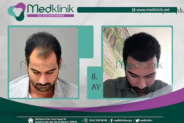 Medklinik Konya Saç Ekimi Merkezi - Resim 20