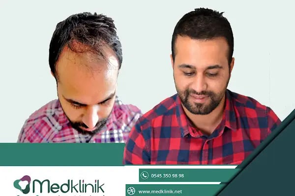 Medklinik Konya Saç Ekimi Merkezi - Resim 10