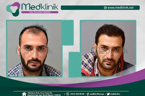 Medklinik Konya Saç Ekimi Merkezi - Resim 12