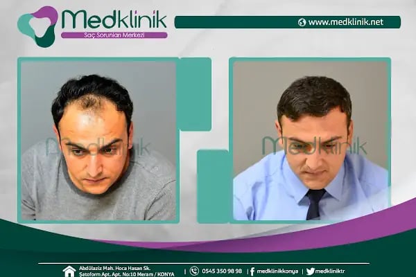 Medklinik Konya Saç Ekimi Merkezi - Resim 7
