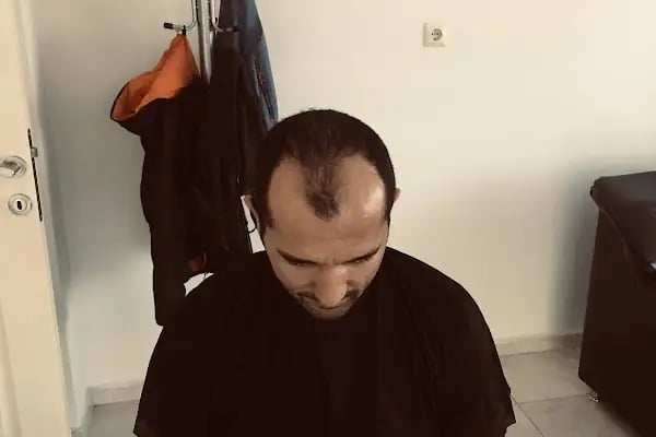 Medklinik Konya Saç Ekimi Merkezi - Resim 4