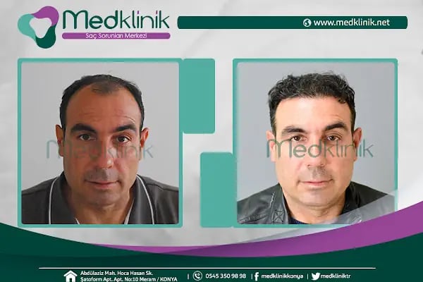 Medklinik Konya Saç Ekimi Merkezi - Resim 9