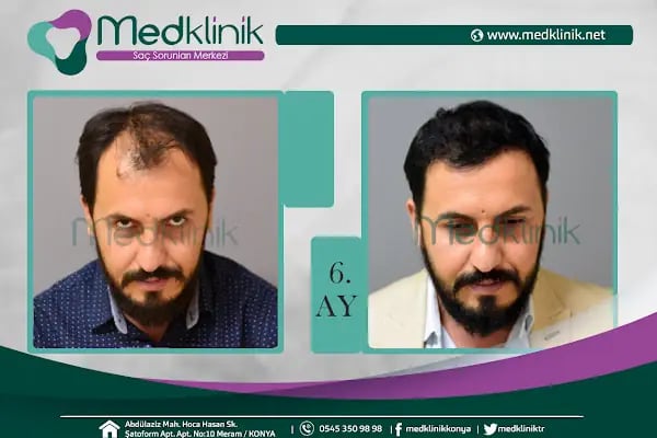 Medklinik Konya Saç Ekimi Merkezi - Resim 19