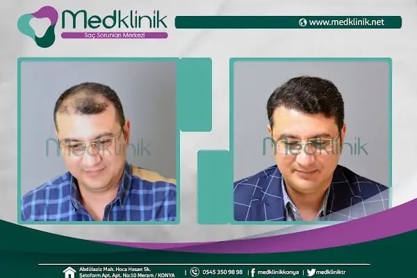 Medklinik Konya Saç Ekimi Merkezi - Resim 14