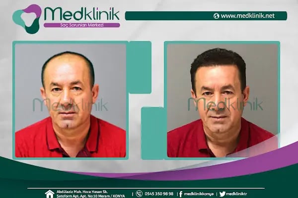 Medklinik Konya Saç Ekimi Merkezi - Resim 11