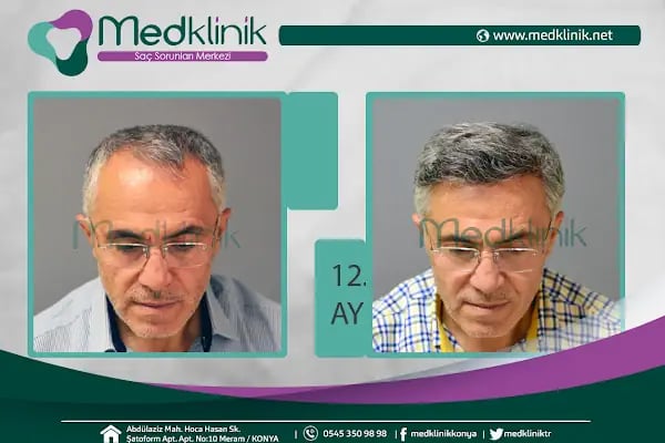 Medklinik Konya Saç Ekimi Merkezi - Resim 17