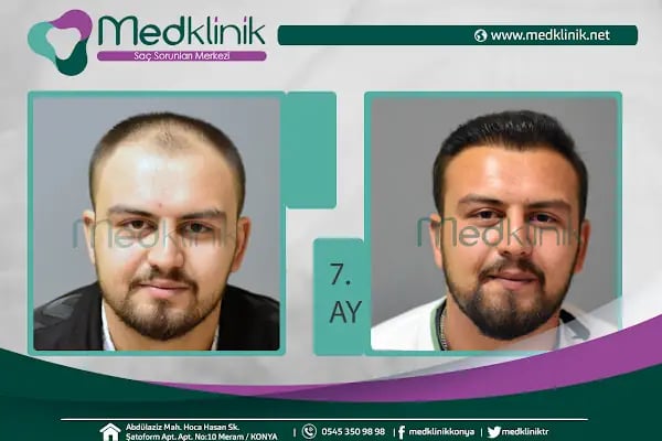Medklinik Konya Saç Ekimi Merkezi - Resim 15