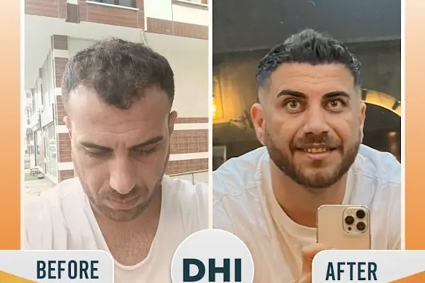 Regardhair Saç Ekim - Resim 19