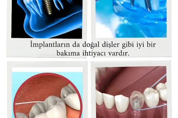 Doç Dr Murat Metin Ağız Diş Çene Cerrahisi Ve İmplant Kliniği - Resim 13