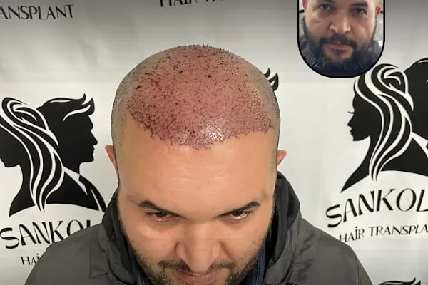 Sankolis İstanbul Hair Transplant - Saç Ekimi İstanbul - Resim 1