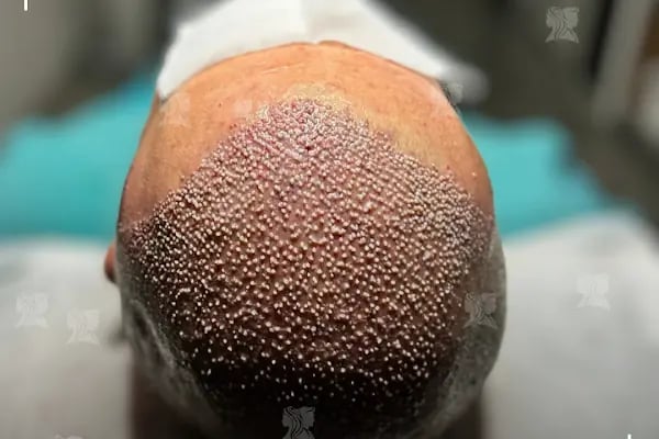 Sankolis İstanbul Hair Transplant - Saç Ekimi İstanbul - Resim 5
