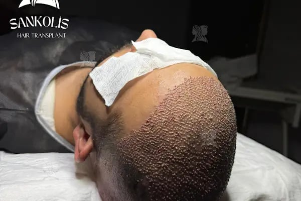 Sankolis İstanbul Hair Transplant - Saç Ekimi İstanbul - Resim 16