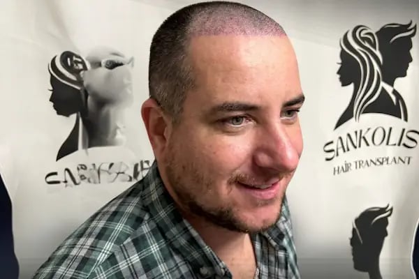 Sankolis İstanbul Hair Transplant - Saç Ekimi İstanbul - Resim 8