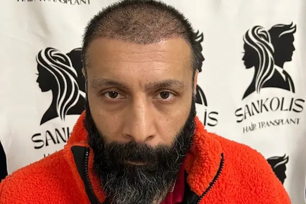 Sankolis İstanbul Hair Transplant - Saç Ekimi İstanbul - Resim 11