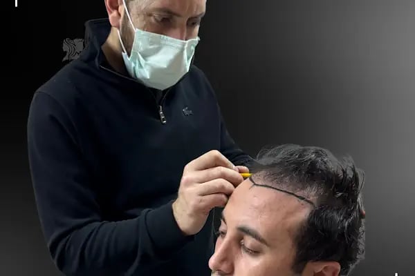 Sankolis İstanbul Hair Transplant - Saç Ekimi İstanbul - Resim 6