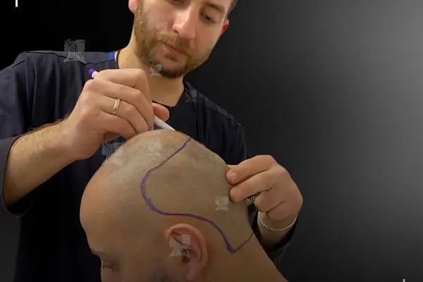 Sankolis İstanbul Hair Transplant - Saç Ekimi İstanbul - Resim 20