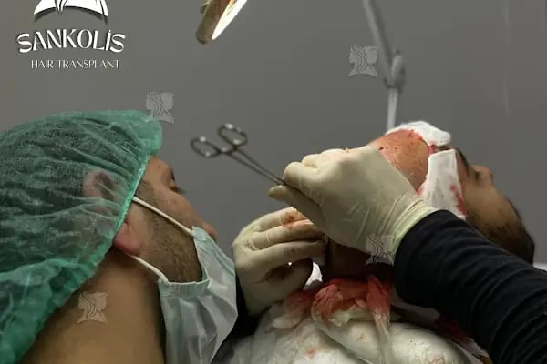 Sankolis İstanbul Hair Transplant - Saç Ekimi İstanbul - Resim 18