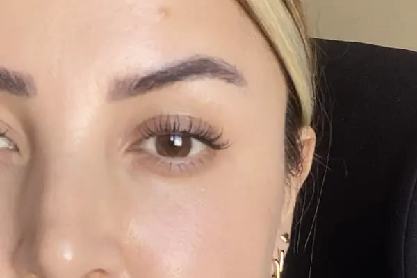 Uzm. Dr. Tayfun Koçoğlu Kliniği Ankara | Botoks | Dolgu | Mezoterapi | Lazer Epilasyon - Resim 6