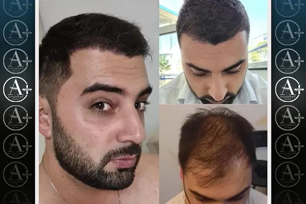 Mediavrupa Saç Ekim | Hair Transplant Turkey Istanbul | Saç Ekim Merkezi İstanbul | FUE Saç Ekimi | DHİ Saç Ekimi | - Resim 5