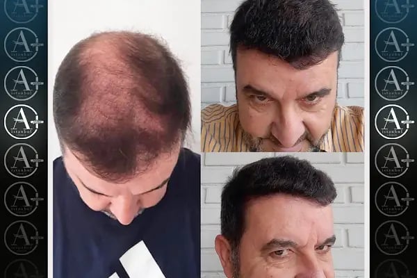 Mediavrupa Saç Ekim | Hair Transplant Turkey Istanbul | Saç Ekim Merkezi İstanbul | FUE Saç Ekimi | DHİ Saç Ekimi | - Resim 2
