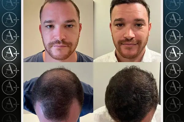 Mediavrupa Saç Ekim | Hair Transplant Turkey Istanbul | Saç Ekim Merkezi İstanbul | FUE Saç Ekimi | DHİ Saç Ekimi | - Resim 3