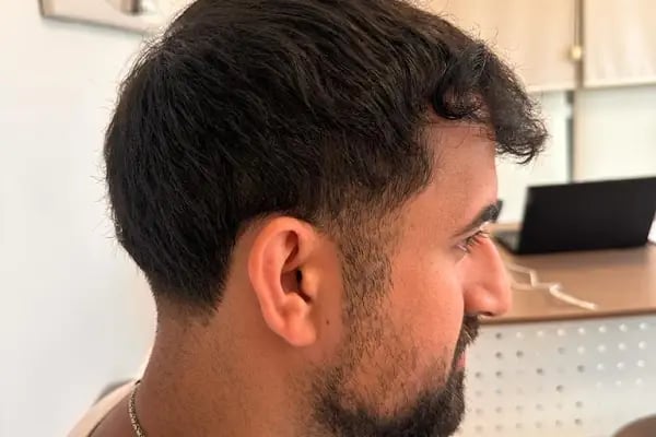 Bilyana Hair Clinic Saç Ekim Merkezi - Resim 10