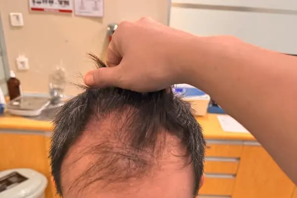 Bilyana Hair Clinic Saç Ekim Merkezi - Resim 6