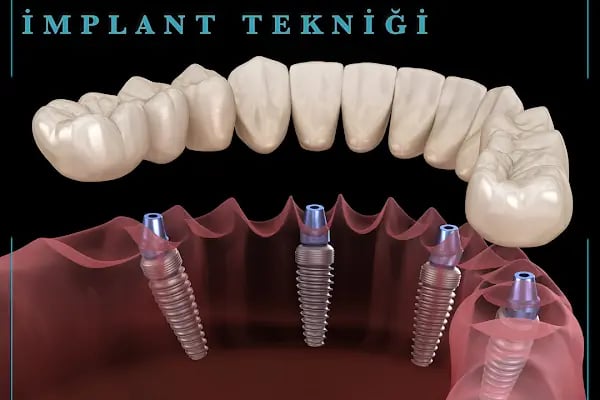 Özel Ensar dent Ağız ve Diş Sağlığı Polikliniği - Resim 14