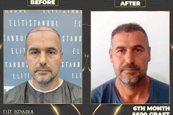 Elit İstanbul Hair Transplant - Resim 12