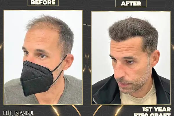 Elit İstanbul Hair Transplant - Resim 17