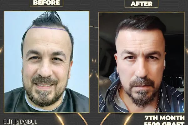 Elit İstanbul Hair Transplant - Resim 11