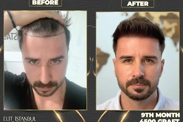 Elit İstanbul Hair Transplant - Resim 16