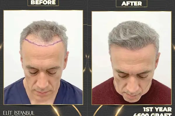 Elit İstanbul Hair Transplant - Resim 20