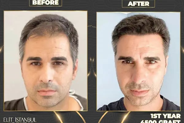 Elit İstanbul Hair Transplant - Resim 14