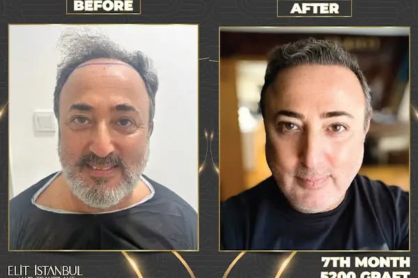 Elit İstanbul Hair Transplant - Resim 8