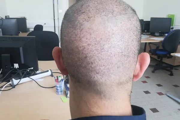 Elit İstanbul Hair Transplant - Resim 4