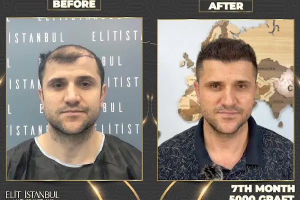 Elit İstanbul Hair Transplant - Resim 13