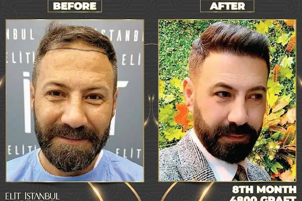 Elit İstanbul Hair Transplant - Resim 7