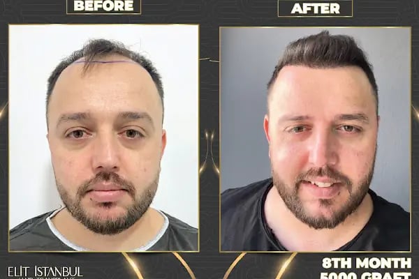 Elit İstanbul Hair Transplant - Resim 15