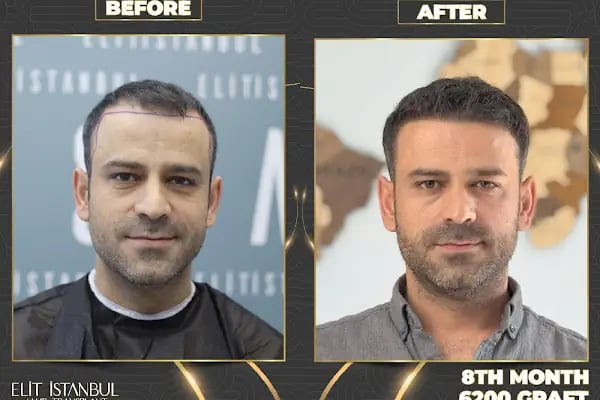 Elit İstanbul Hair Transplant - Resim 9